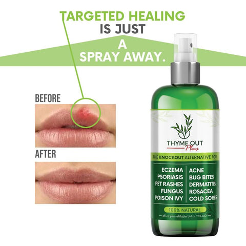 Thyme Out - Tratamento Plus para Eczema, Psoríase – Acne, Dermatite, Rosácea, Aftas, Irritações de Pele, Picadas de Insetos, Hera Venenosa – Spray Anti Coceira para Alívio de Pele Irritada – Crianças, Adultos