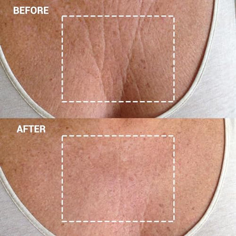 Patches de Silicone Reutilizáveis Wrinkles Schminkles para Rugas no Peito – Suaviza e Hidrata a Pele do Decote – 100% Eficaz