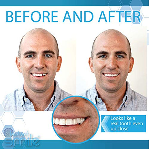 Kit de Substituição Temporária de Dente Instant Smile Complete Your Smile – Substitua um Dente Ausente em Minutos – Patenteado