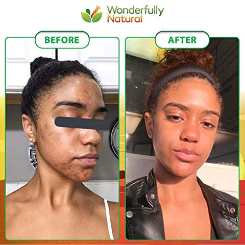 Wonderfully Natural - Sabonete Negro Africano Orgânico – Para Acne : [Nome da Marca]