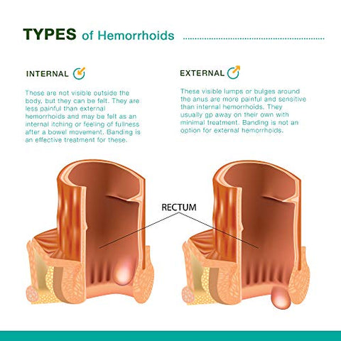 Reejoys - Creme para Hemorroidas: Tratamento Eficaz, Alívio Rápido – Marca Hemorrelief