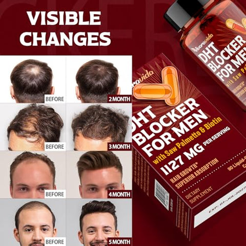 Vivaravida - Bloqueador de DHT para Homens | Suplemento para Crescimento Capilar com Saw Palmetto