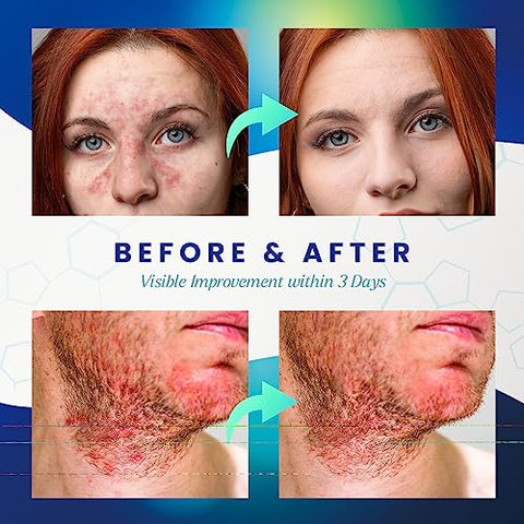 PURESKIN - Creme Dermatite Seborreica Ketoconazol: Tratamento Psoríase Eczema para Pele Couro Cabeludo – Alívio Natural para Descamação Irritação 100ml