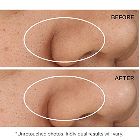 StriVectin Pads e Cristais Esfoliantes para Rosto e Corpo, Removendo Pele Morta para uma Pele Lisa e Macia  StriVectin