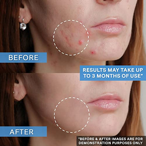 Gel Adapaleno 0.1% – Tratamento Acne – 90 Dias (45g Tubo XL) – Retinoide Tópico – Elimine Cravos e Espinhas - Curist