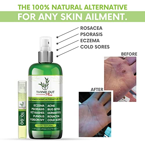 Thyme Out - Tratamento Plus para Eczema, Psoríase – Acne, Dermatite, Rosácea, Aftas, Irritações de Pele, Picadas de Insetos, Hera Venenosa – Spray Anti Coceira para Alívio de Pele Irritada – Crianças, Adultos