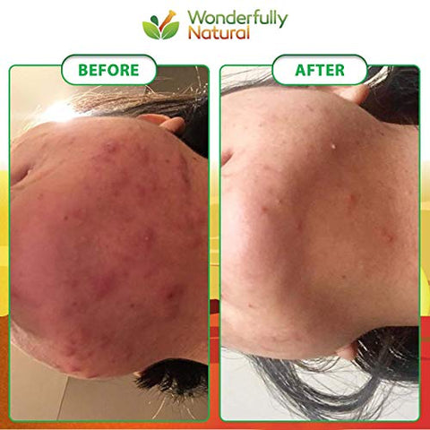 Wonderfully Natural - Sabonete Negro Africano Orgânico – Para Acne : [Nome da Marca]