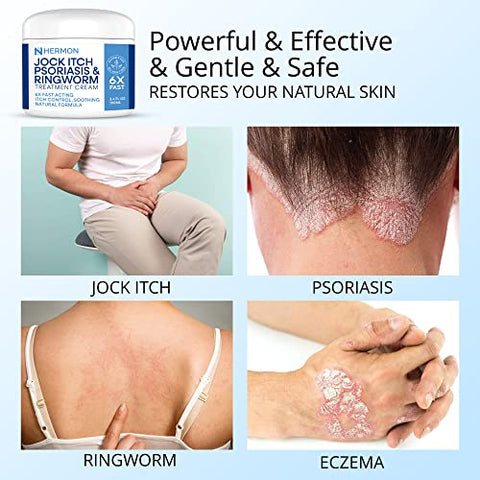 Hermon - Creme Antifúngico Jock Itch, Creme para Psoríase, Tratamento para Micose em Humanos, Tratamento para Psoríase, Tratamento para Couro Cabeludo com Psoríase, Creme para Micose em Humanos, Pés