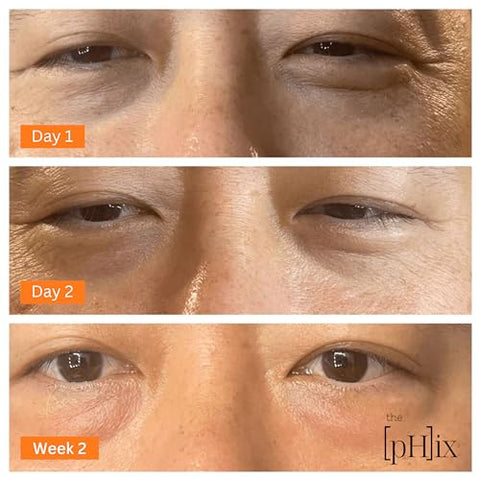 THE PHIX - Creme para os Olhos com Cafeína, Ácido Hialurônico, Vitamina E e Vitamina K – Vegano (Para Olheiras, Inchaço Facial, Rugas e Linhas Finas)