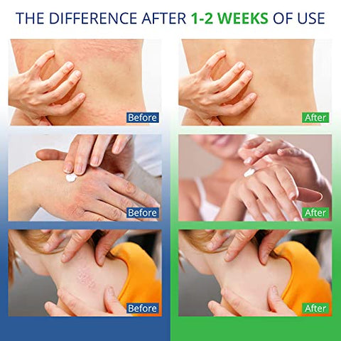 Hermon - Creme Antifúngico Jock Itch, Creme para Psoríase, Tratamento para Micose em Humanos, Tratamento para Psoríase, Tratamento para Couro Cabeludo com Psoríase, Creme para Micose em Humanos, Pés
