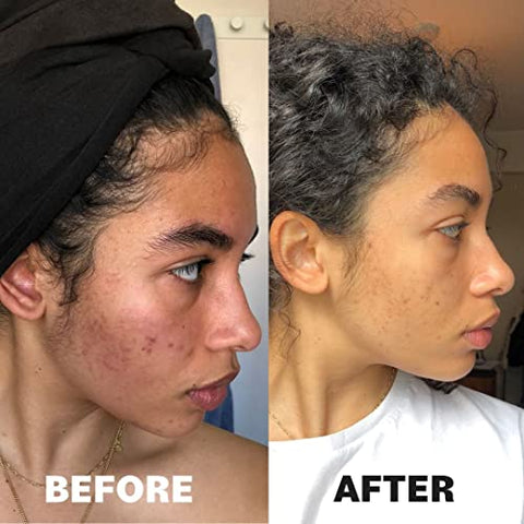 Pore Favor - POREFAVOR – Suplemento para Acne com DIM e Zinco 10 ativos, combate as 4 fases do desenvolvimento da acne. Vitaminas para Pele Limpa, Manchas e Imperfeições